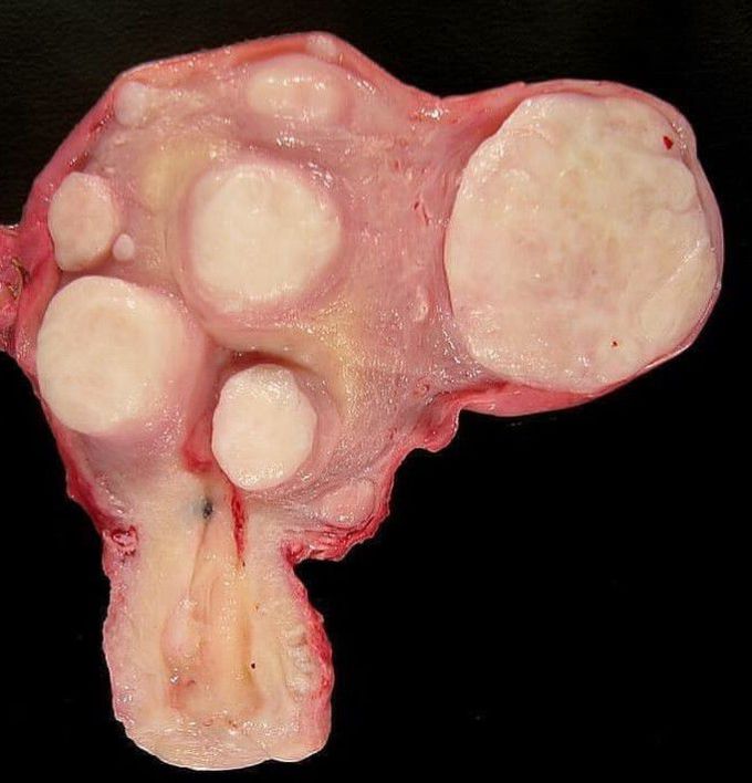 Uterus with multiple fibroids