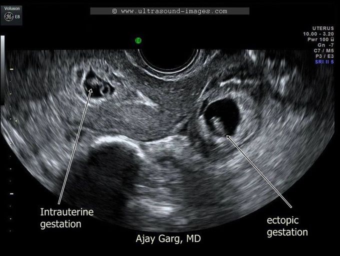 Heterotopic pregnancy in which both intrauterine pregnancy &extrauterine pregnancy (ectopic pregnancy)) are occure simultaneously...it occur in vitru fertilization(IVF)
