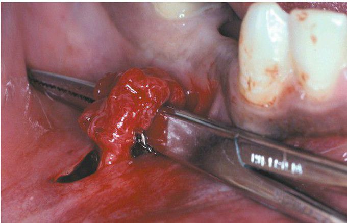 Traumatic Neuroma