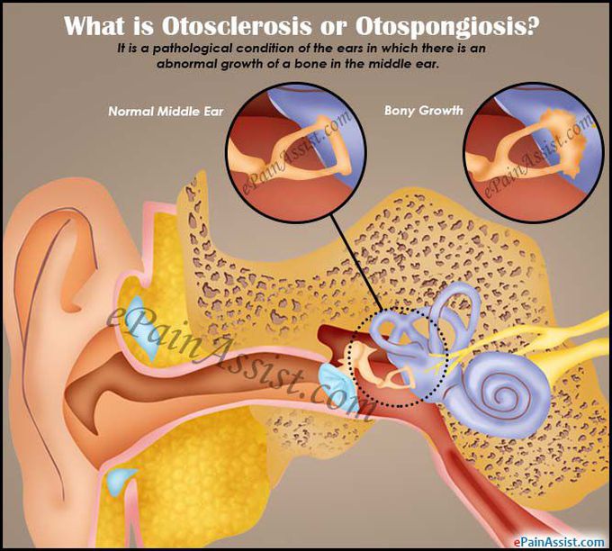 Otosclerosis Diagnosis Evaluation Pathology Surgical Techniques