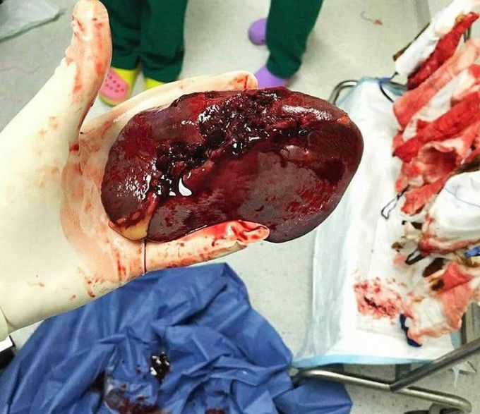 A ruptured spleen