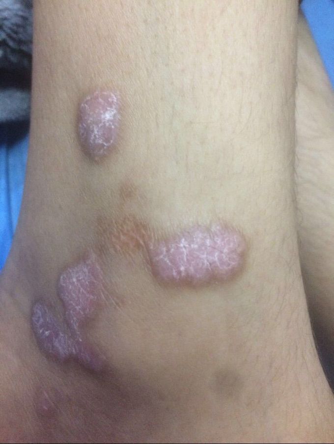 Psoriasis