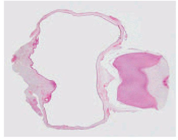 Development of a cyst