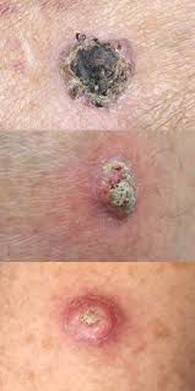 Complications of squamous cell carcinoma