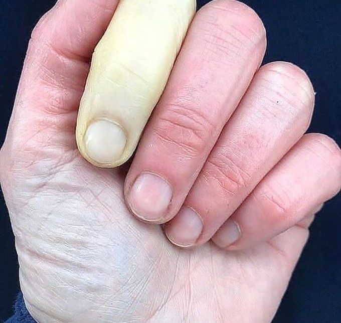 Raynaud's syndrome