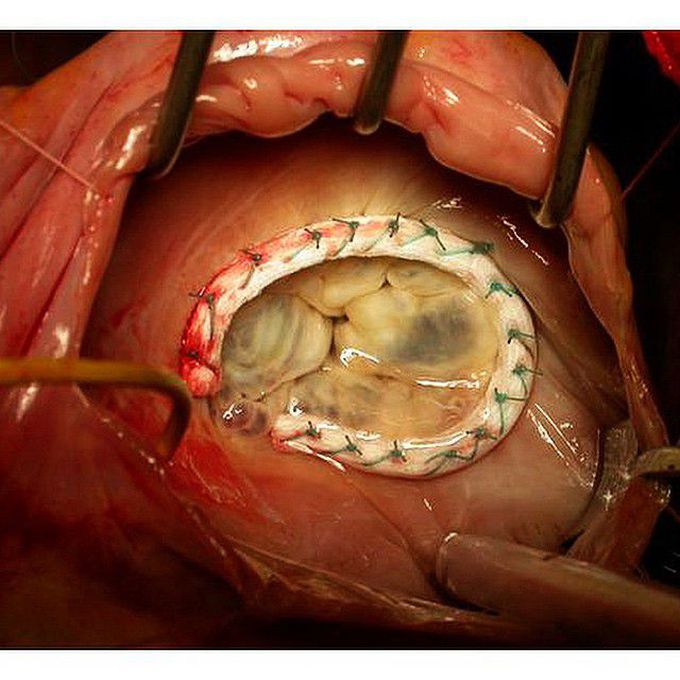 Tricuspid Valve Annuloplasty Using Semiflexible Ring!  