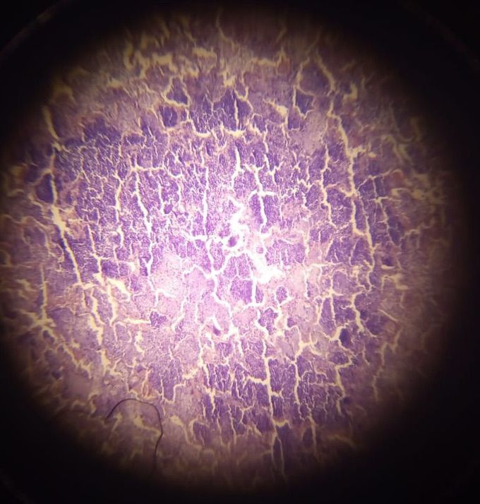 bronchopneumonia fibrosis