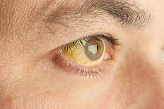 What causes yellow fever?