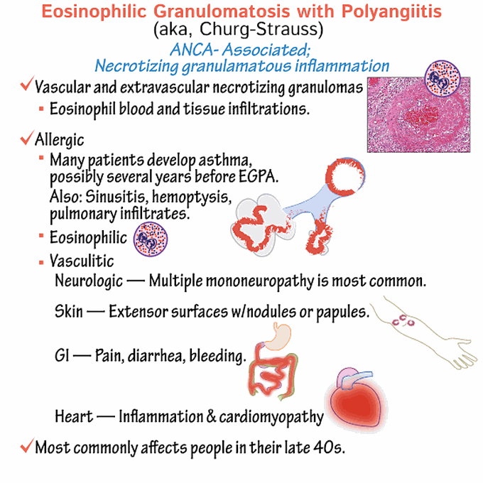 Churg-Strauss Disease