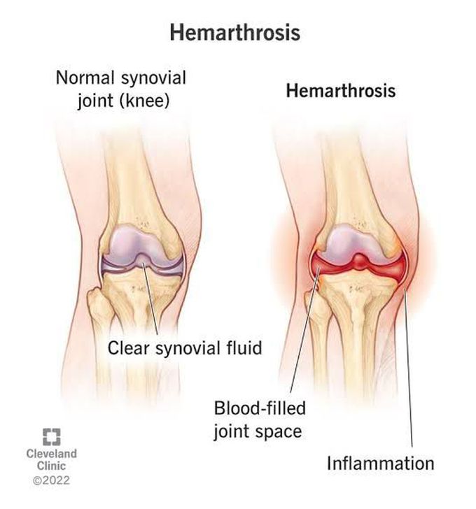 Hemarthrosis