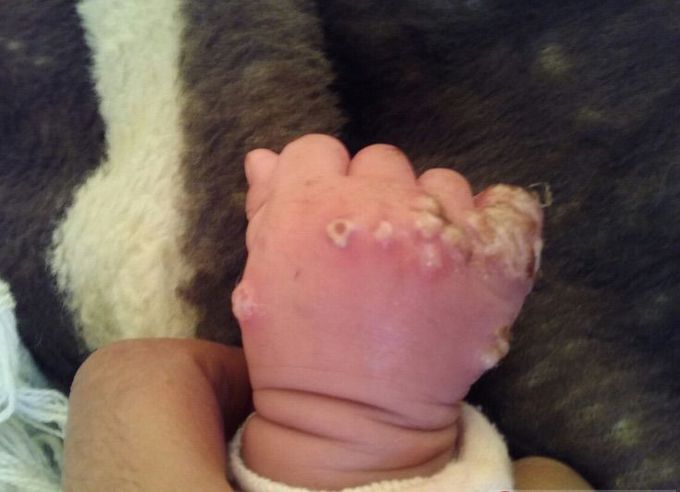 Molluscum contagiosum