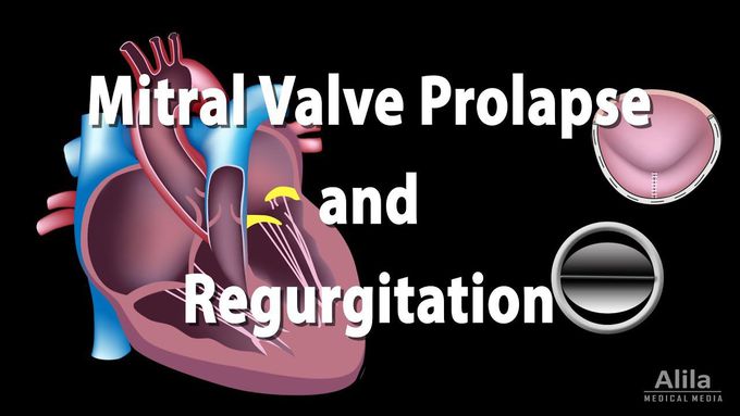 Mitral Valve Prolapse and Regurgitation, Animation