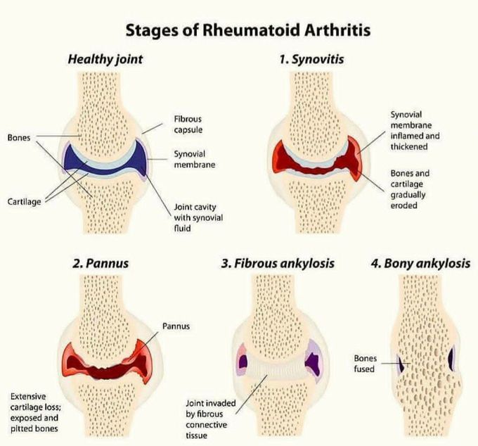 Rheumatoid arthritis