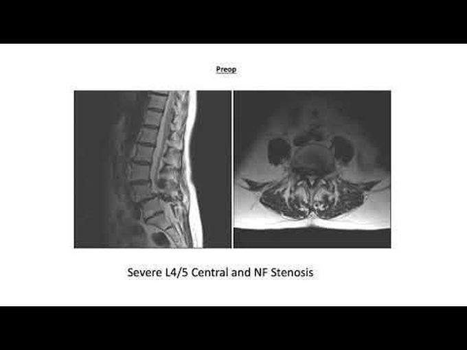 AANS Coding Shorts: Transforaminal Lumbar Interbody Fusion (TLIF)