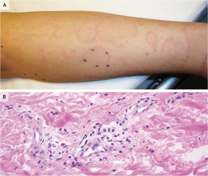 Acute Rheumatic Fever with Erythema Marginatum