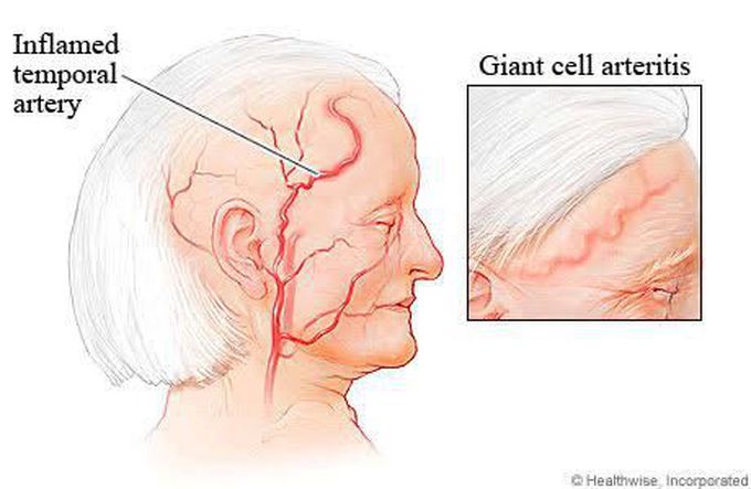 Symptoms of arteritis