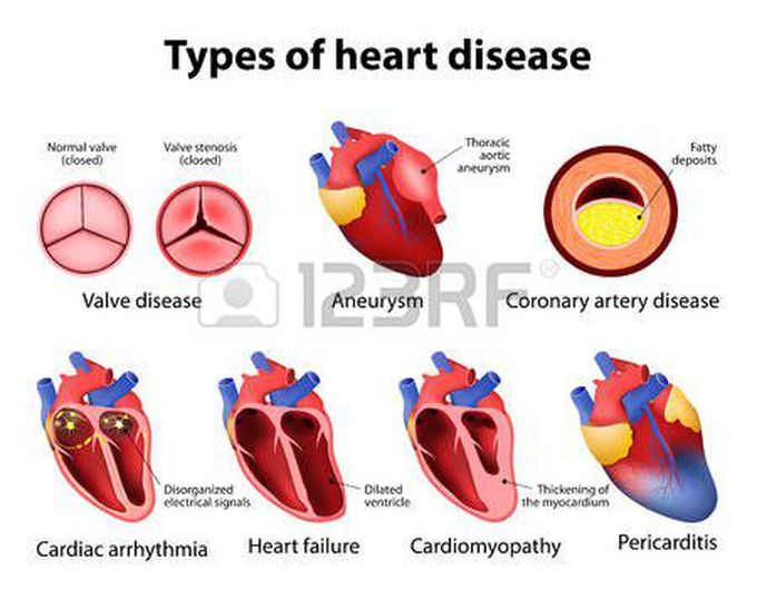 Types of heart disease