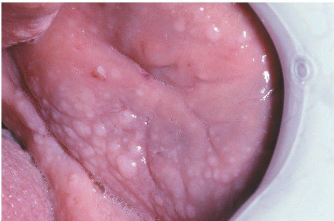 Multiple Hamartoma Syndrome.