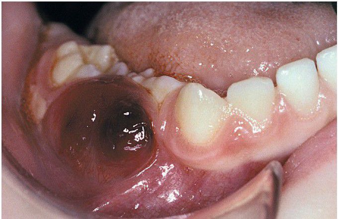 Langerhans Cell Histiocytosis