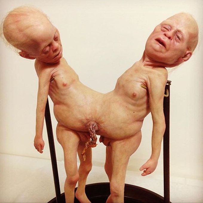 This is how conjoined twins look like!