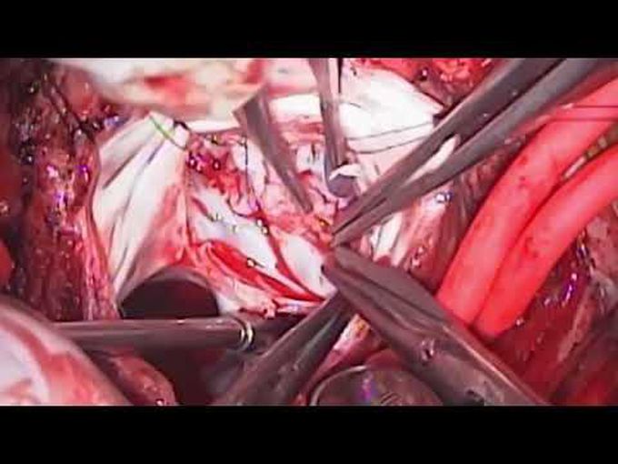 The da Silva Cone Operation After the Starnes Procedure for Ebstein's Anomaly