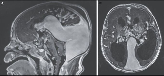 Vein of Galen Malformation