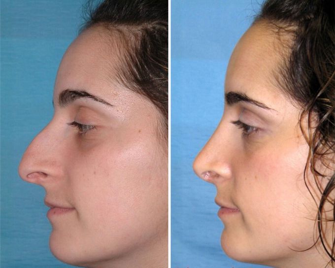 Rhinoplasty