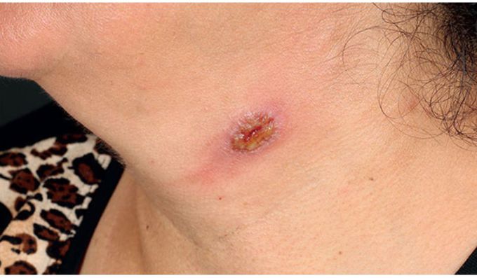 What is your diagnosis based on the clinical picture?