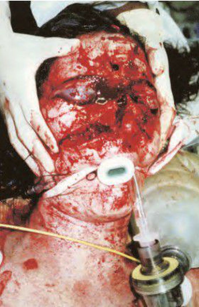 Severe Craniofacial Injuries