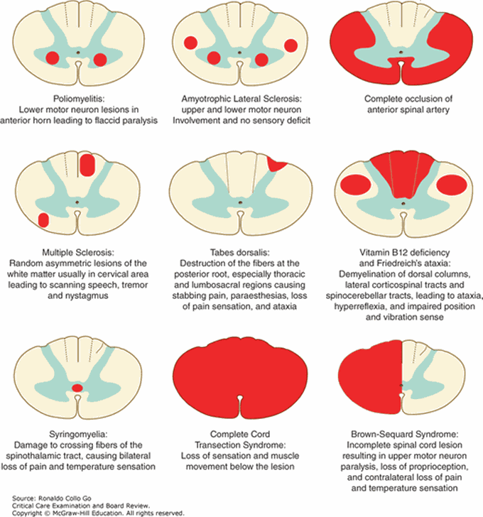 Spinal cord syndrome