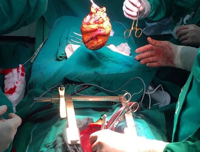 cardiovascular surgery