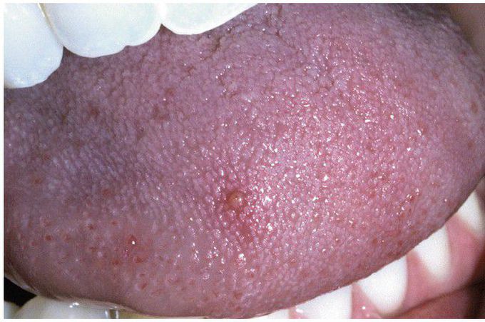 Transient Lingual Papillitis