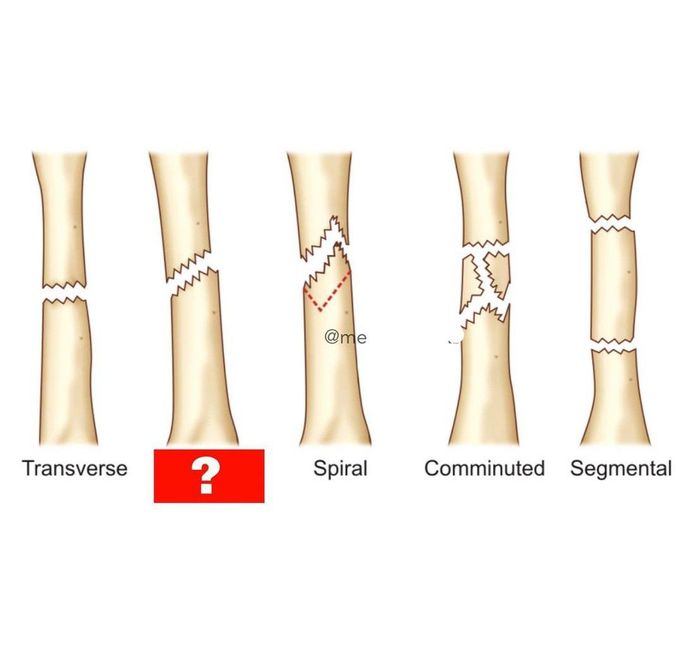 Types of fracture