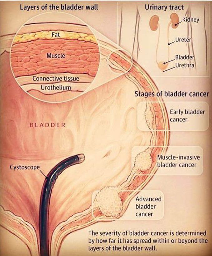 Bladder cancer..