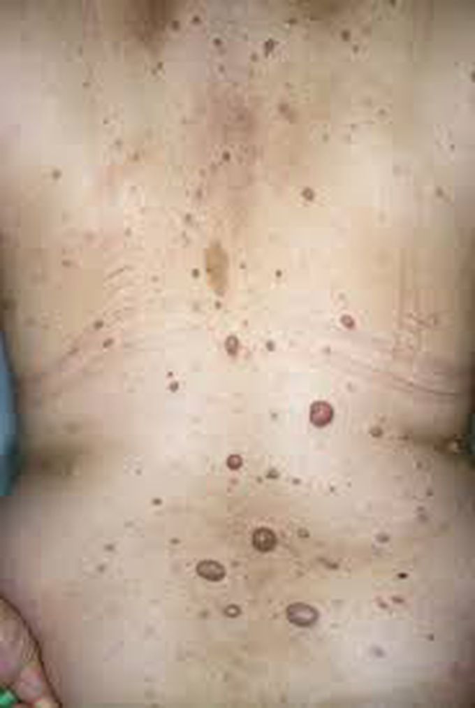 Neurofibroma