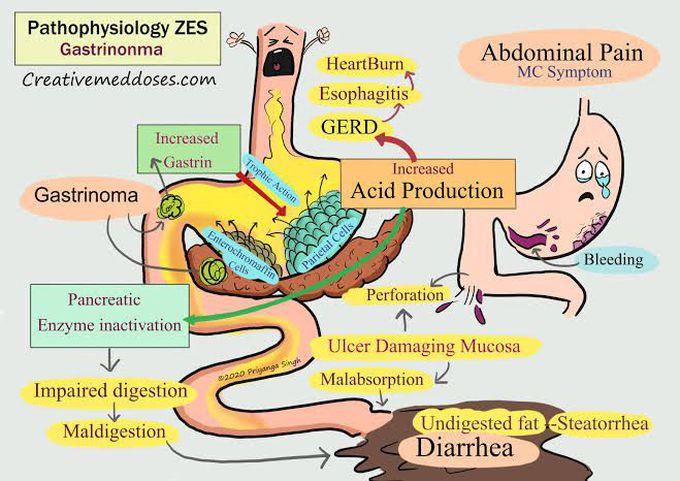 Pathophysiology of ZES