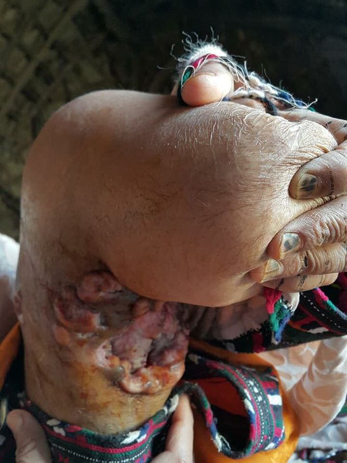 A 30 year old female, amputated leg