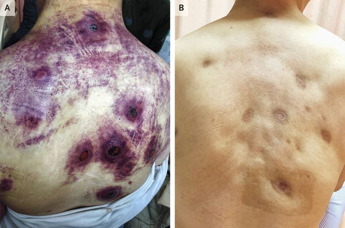 Extranodal Natural Killer T-Cell Lymphoma