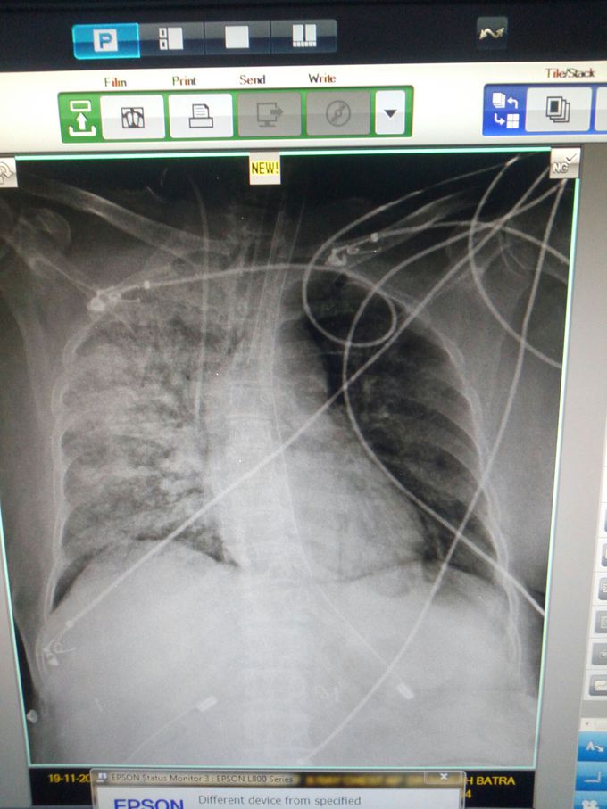 Sp02 is 92℅ on ventilator , weight is 50 kg , select a mode of ventilation and settings