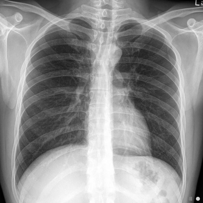 What parts do you see in this CXR?