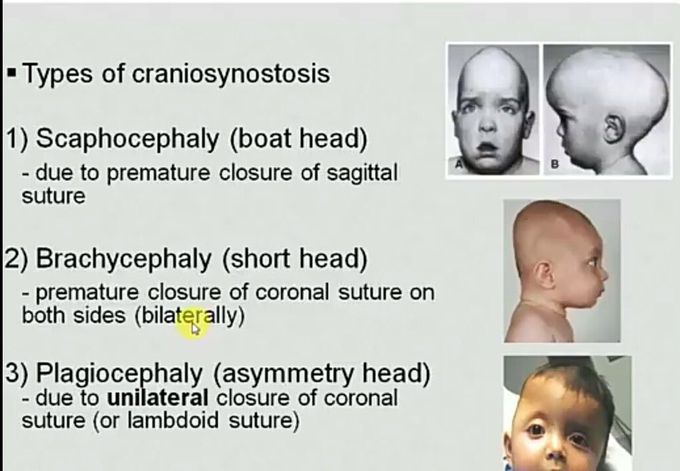 Type of craniosynostsis