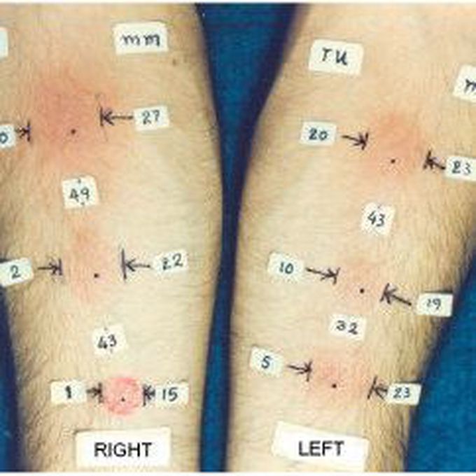 Tuberculin Skin Test MEDizzy