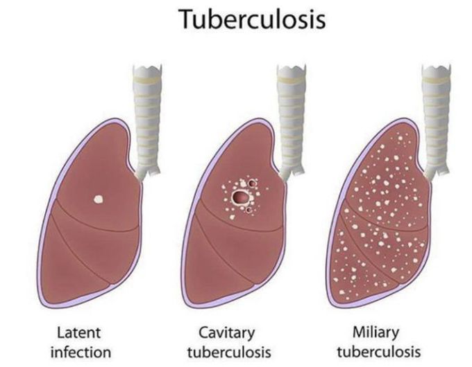 TUBERCULOSIS