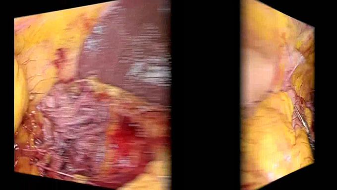 Laparoscopic Right Hemicolectomy – A Stepwise Approach for the Trainee