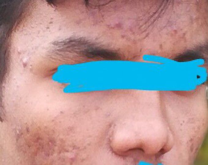 Acne ,scars
