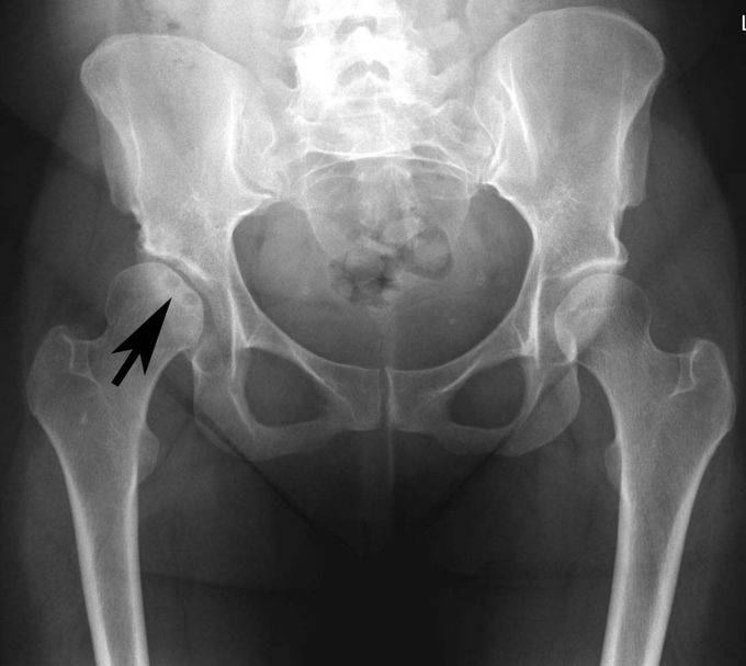 Avascular Necrosis of the femoral head