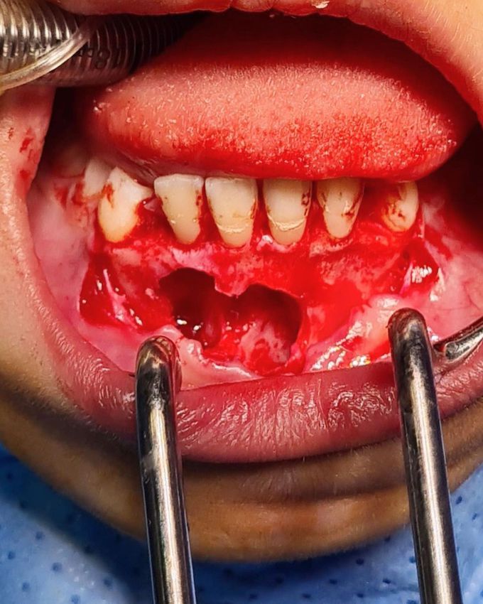 Impacted Canines Removal