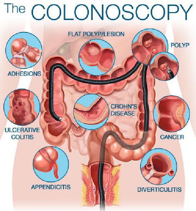 COLONOSCOPY