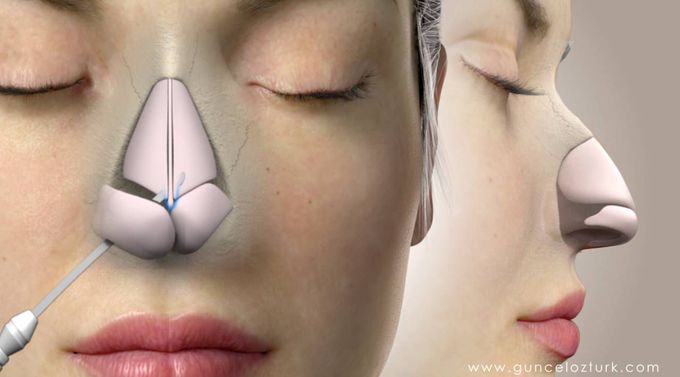 Nose plastic surgery- 3D model