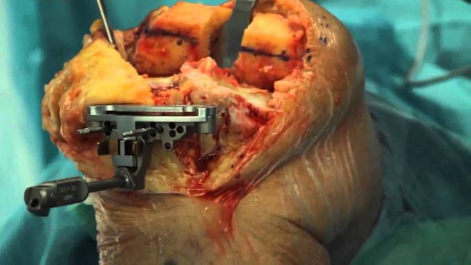 TOTAL KNEE REPLACEMENT FOR A VARUS DEFORMITY